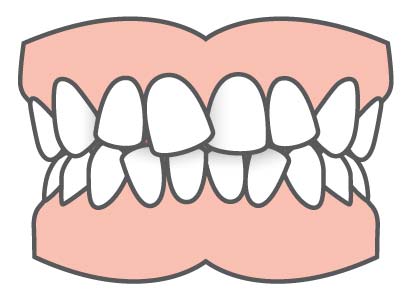 Common Orthodontic Problems