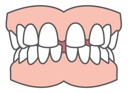 Common Orthodontic Problems